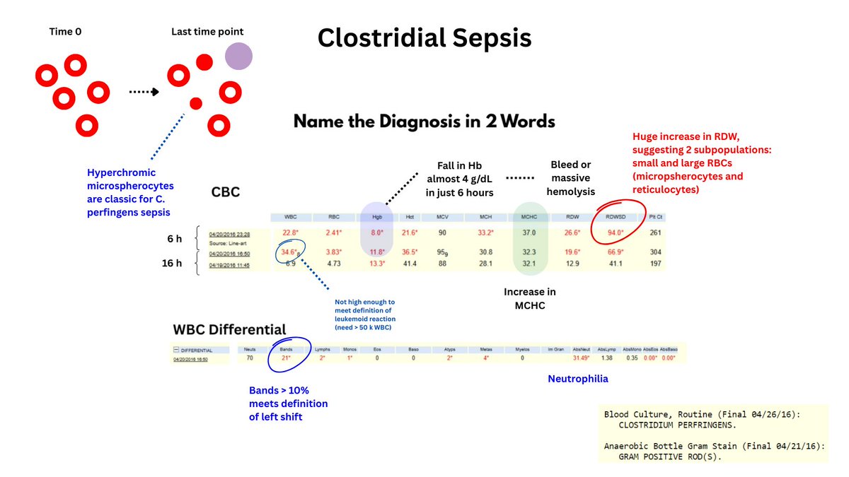 1/2

CLOSTRIDIAL PERFRINGENS

I recently posted a CBC and diff, asking for the diagnosis in 2 words.

CORRECT ANSWER: CLOSTRIDIAL SEPSIS

What were the hints?

1. RAPID drop in Hb/Hct
2. Increase in RDW
3. Increase in MCHC
4. Leukocytosis with left shift