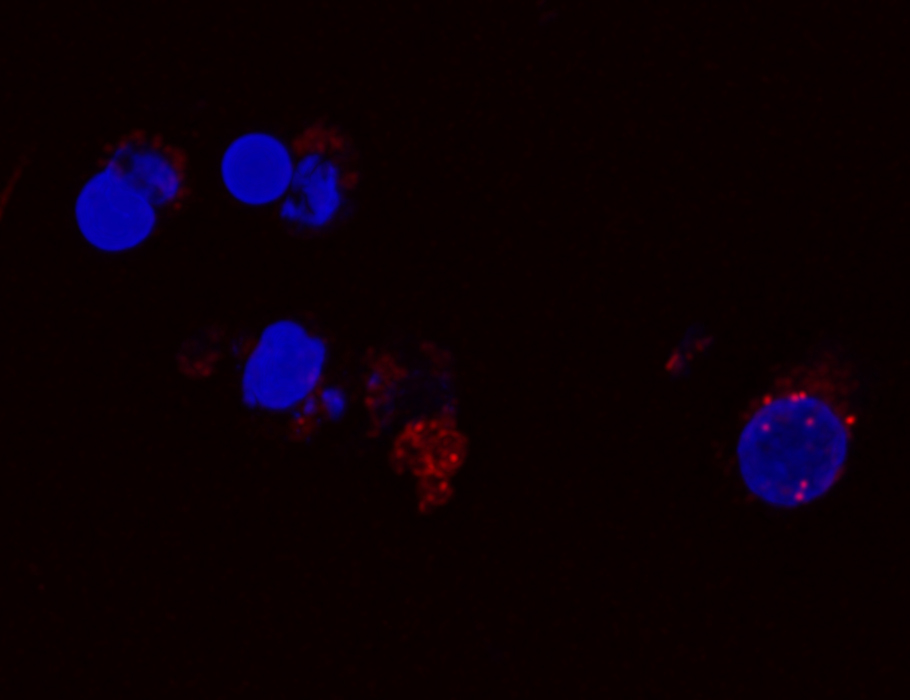 Science Magazine (@sciencemagazine) on Twitter photo Scientists have uncovered how abdominal fluid called ascites in patients with high-grade serous ovarian cancer suppresses antitumor cytotoxicity in natural killer cells.
Learn more in <a href="/SciImmunology/">Science Immunology</a>: scim.ag/4iXrKB1 Scientists have uncovered how abdominal fluid called ascites in patients with high-grade serous ovarian cancer suppresses antitumor cytotoxicity in natural killer cells.
Learn more in <a href="/SciImmunology/">Science Immunology</a>: scim.ag/4iXrKB1