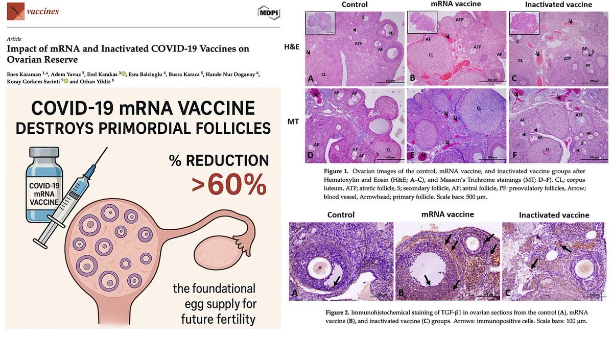 Verein WIR (@verein_wir) on Twitter photo 🔴COVID-19-mRNA-Injektionen zerstören über 60 % des nicht erneuerbaren Eizellvorrats von Frauen
▪️uncutnews.ch/covid-19-mrna-…
<a href="/ChantalStadelm1/">Chantal Stadelmann</a> <a href="/RealWsiegrist/">Walter Siegrist</a> <a href="/MarcBuergi/">Marc Oliver Bürgi 🇨🇭 🇺🇸</a> <a href="/BoschimoDr/">Dr. Bodo Schiffmann</a> 🔴COVID-19-mRNA-Injektionen zerstören über 60 % des nicht erneuerbaren Eizellvorrats von Frauen
▪️uncutnews.ch/covid-19-mrna-…
<a href="/ChantalStadelm1/">Chantal Stadelmann</a> <a href="/RealWsiegrist/">Walter Siegrist</a> <a href="/MarcBuergi/">Marc Oliver Bürgi 🇨🇭 🇺🇸</a> <a href="/BoschimoDr/">Dr. Bodo Schiffmann</a>