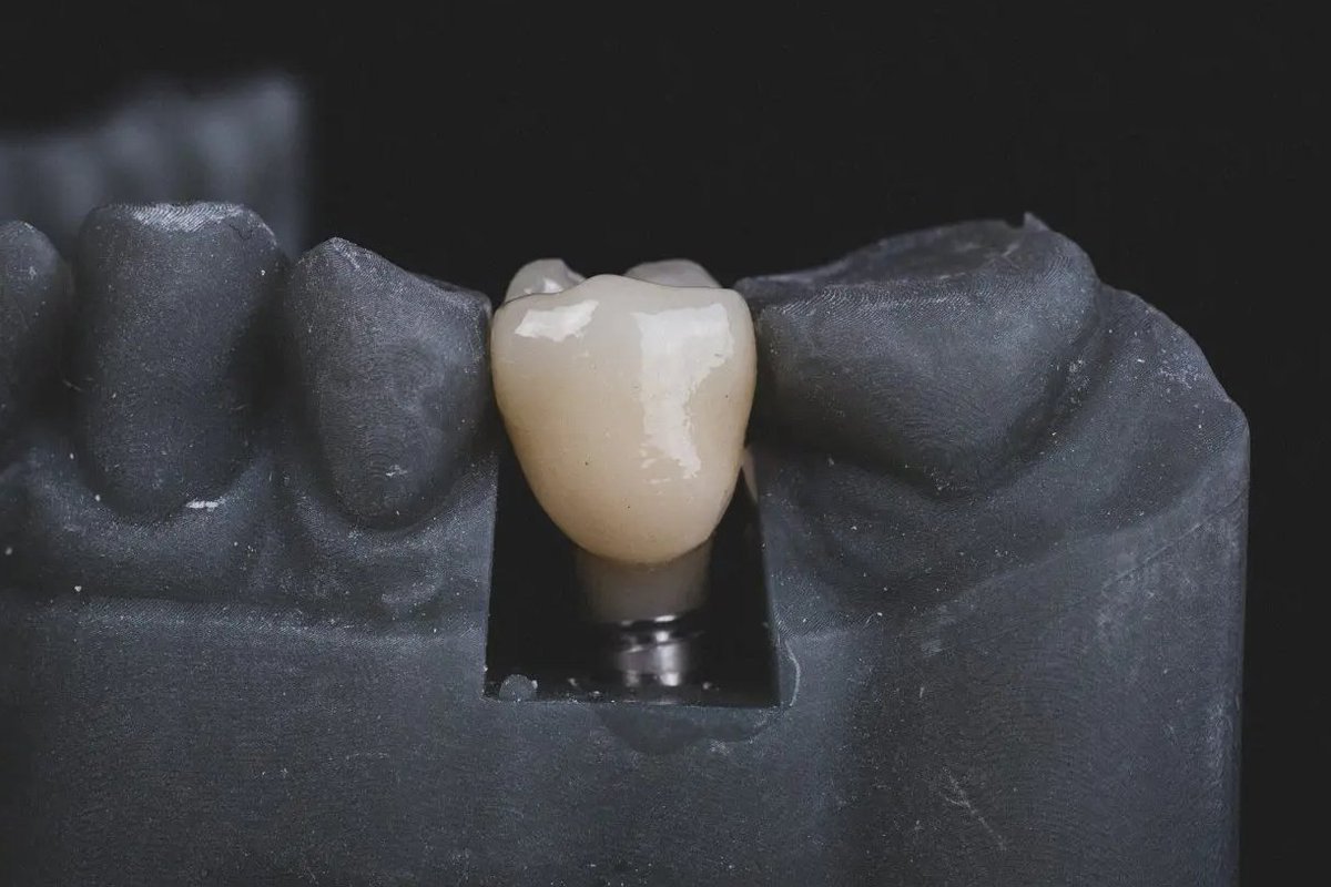 odontomap's tweet photo. 💠 Zirconia sobre Implantes: Precisión, Estética y Durabilidad en Rehabilitación Oral

La rehabilitación oral con coronas de zirconia sobre implantes dentales ha revolucionado el tratamiento restaurador por su combinación ideal de funcionalidad y estética.

#Zirconia https://t.co/gPhLEqCIOS