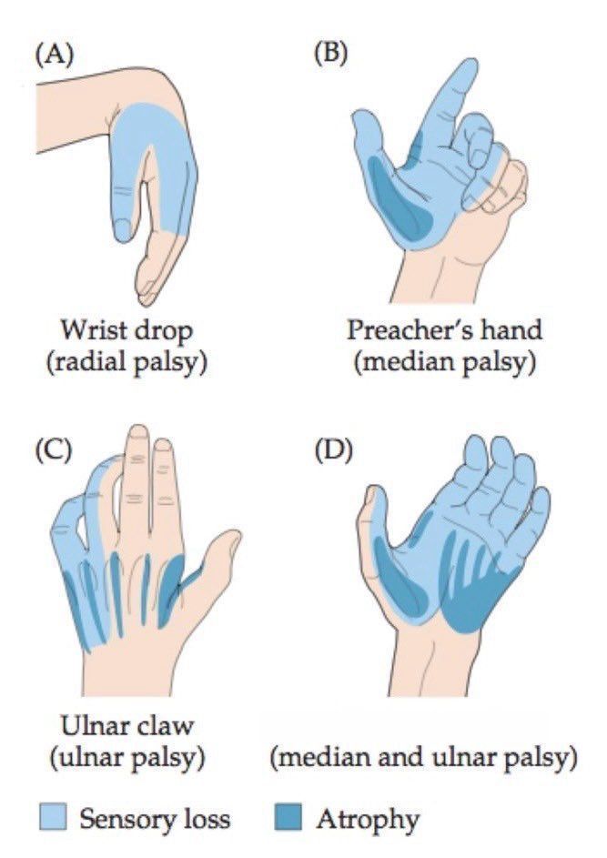 Peripheral nerve presentations of hand
