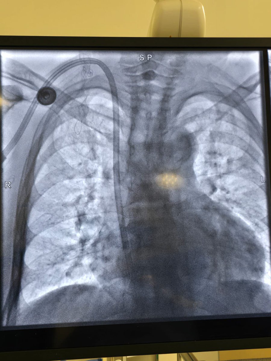 Nestor Mahurkalibur (@ngm2503) on Twitter photo 3er paciente con manejo endovascular por nefrología intervencionista. Fem 44 años catéter temporal de 5 años, con disfunción. Se retira acceso se trata estenosis venosa y se coloca catéter tunelizado. <a href="/ISNkidneycare/">Int Society of Nephrology</a> <a href="/IntervenNephMx/">Nefrología Intervencionista - México</a> <a href="/AVATAROrg/">AVATAR India</a> <a href="/GEMAVsociedad/">GEMAV</a> 🇲🇽 3er paciente con manejo endovascular por nefrología intervencionista. Fem 44 años catéter temporal de 5 años, con disfunción. Se retira acceso se trata estenosis venosa y se coloca catéter tunelizado. <a href="/ISNkidneycare/">Int Society of Nephrology</a> <a href="/IntervenNephMx/">Nefrología Intervencionista - México</a> <a href="/AVATAROrg/">AVATAR India</a> <a href="/GEMAVsociedad/">GEMAV</a> 🇲🇽