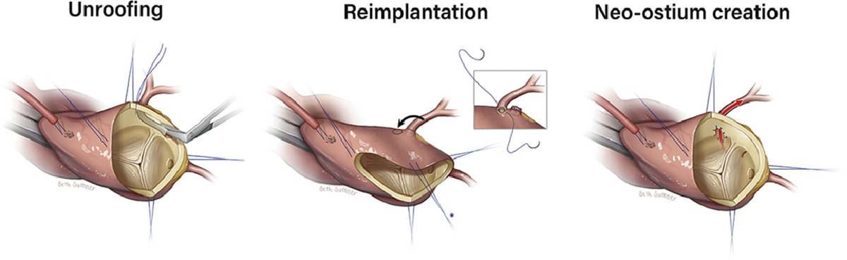 AATS (@aatshq) on Twitter photo Invited Expert Technique: What is the Optimal Surgical Technique for Anomalous Aortic Origin of a Coronary Artery? Read more from Carlos Mery and Ziv Beckerman at <a href="/VUMCchildren/">Children's at VUMC</a> in Seminars in Thoracic and Cardiovascular Surgery: doi.org/10.1053/j.pcsu⦠Invited Expert Technique: What is the Optimal Surgical Technique for Anomalous Aortic Origin of a Coronary Artery? Read more from Carlos Mery and Ziv Beckerman at <a href="/VUMCchildren/">Children's at VUMC</a> in Seminars in Thoracic and Cardiovascular Surgery: doi.org/10.1053/j.pcsuā¦