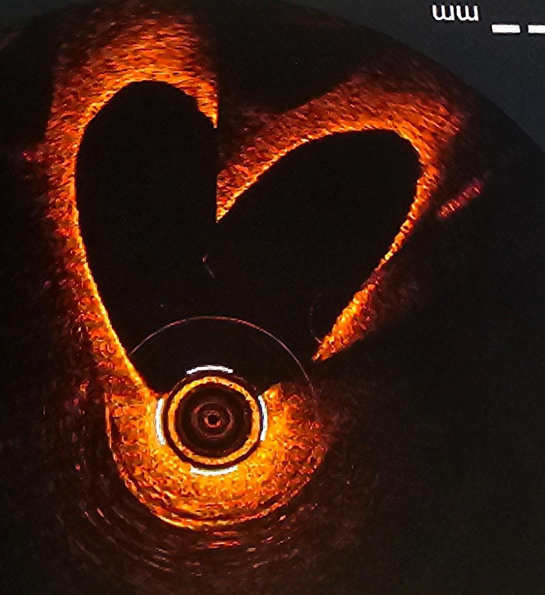 Antonio Gomez Menchero (@antoniogomezm21) on Twitter photo Nunca un artefacto nos ha representado mejor, La imagen intravascular protege tu corazón . Complex PCI & Intravascular imagine. #OCTfirst <a href="/ElenaIzaga/">Izaga</a> <a href="/CamachoFreire/">Santiago Jesús Camacho Freire</a> <a href="/CarmenLluch3/">Carmen Lluch</a> <a href="/IHujrj/">Intervencionismo Huelva HUJRJ</a> <a href="/PCRonline/">PCRonline 🫀</a> Nunca un artefacto nos ha representado mejor, La imagen intravascular protege tu corazón . Complex PCI & Intravascular imagine. #OCTfirst <a href="/ElenaIzaga/">Izaga</a> <a href="/CamachoFreire/">Santiago Jesús Camacho Freire</a> <a href="/CarmenLluch3/">Carmen Lluch</a> <a href="/IHujrj/">Intervencionismo Huelva HUJRJ</a> <a href="/PCRonline/">PCRonline 🫀</a>