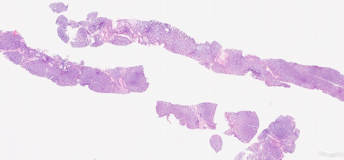 #GUpath renal mass biopsy from an adult human

any wagers from this #LPpath shot?