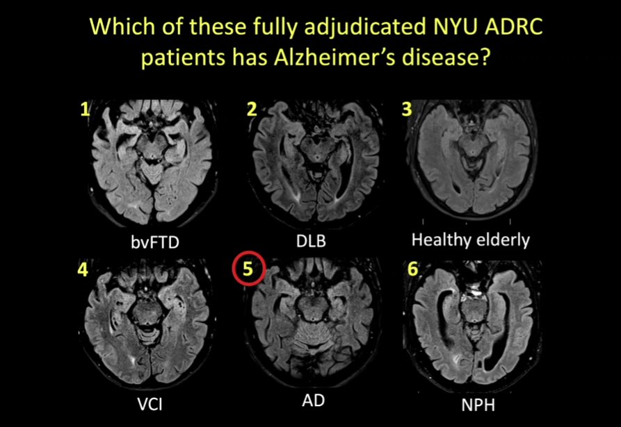 MarkMamloukMD's tweet image. We were honored to host @tim0shepherd from @NYUImaging for our Northern California TPMG Neuroradiology Visiting Lecture Series! @aboutKP
To the radiologist: “You will be surprised how often you are the first to suggest a workup or diagnosis (of a neurodegenerative disease)”