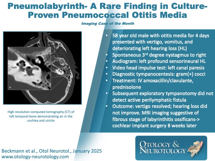 Imaging case of the month: “Pneumolabyrinth- a rare finding in culture-proved pneumococcal otitis media.” #Otology ow.ly/Sb9W50VIqKw