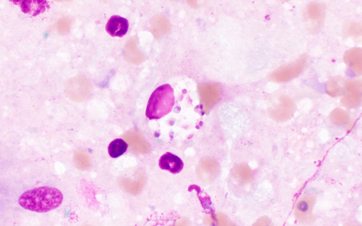 Bobbi Pritt, MD tweet media