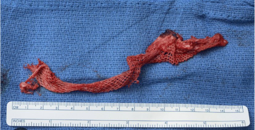 Mesh removals are complex pelvic reconstruction that take many hours and a lot of skill - 
skills that were not available when these plastic devices were first placed in the medical field 

Experimental insertion - experimental removal = a double whammy of harm &amp; injury that