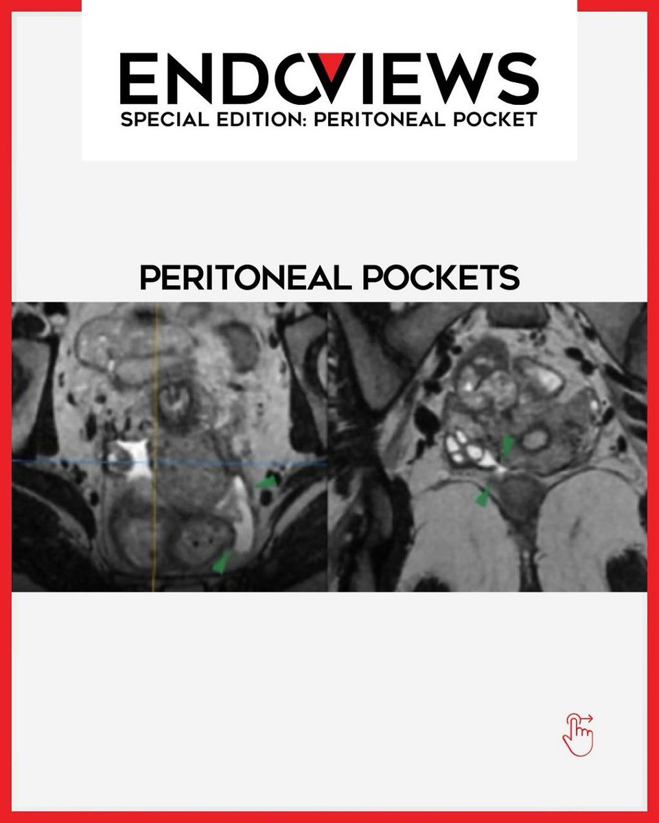 endoviews's tweet image. Com satisfação apresentamos a Special Edition: Peritoneal Pockets. Também chamadas de bolsas de Allen-Masterson, são defeitos no peritônio que permitem a passagem de líquido para espaços extraperitoneais. Um achado sutil, mas relevante na imagem da endometriose.
Acompanhem!