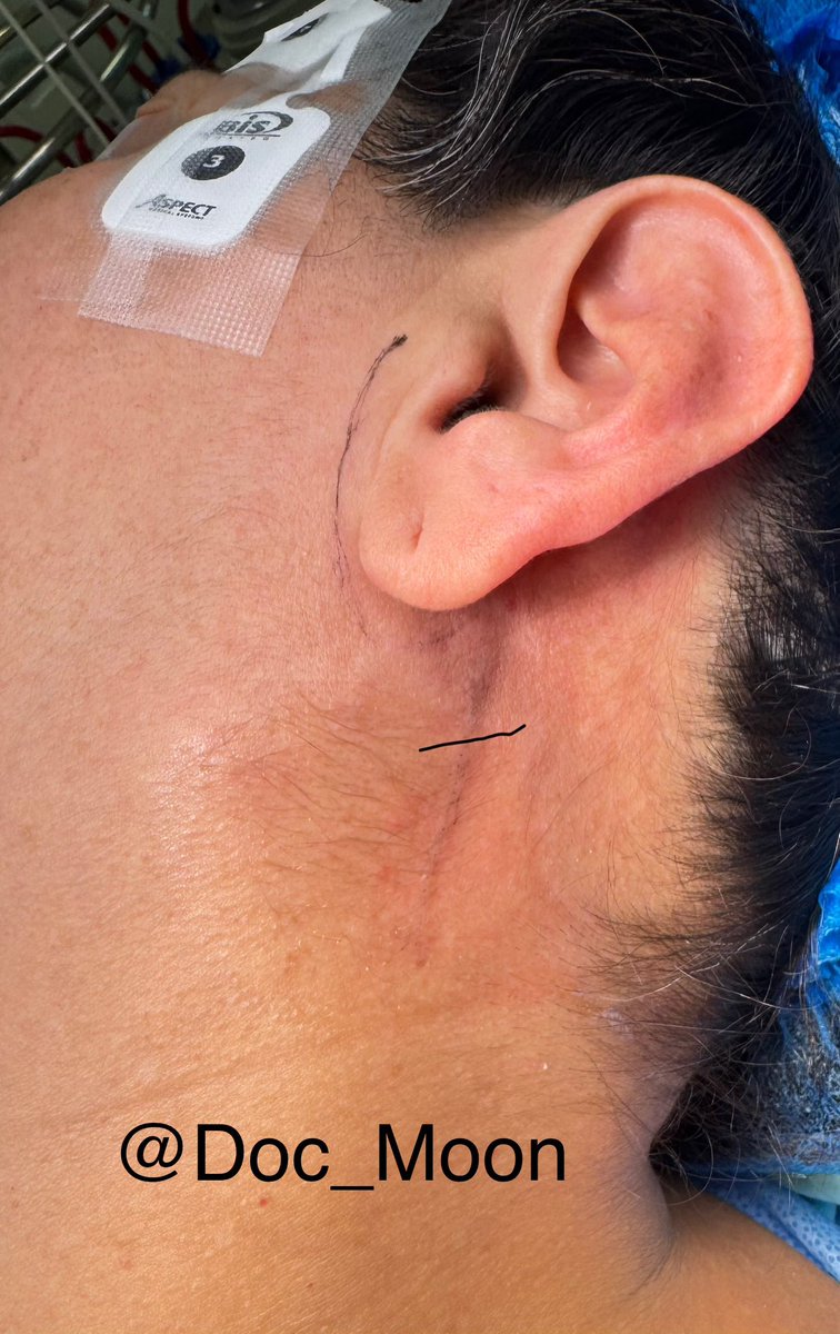 Doc_Moon's tweet image. Hoy operamos un tumor de parótida que es la glándula que produce saliva. Cirugía delicada ya que puede traer como complicaciones alteraciones importantes de la mímica facial. #surgeonlife #surgeons #parotida
