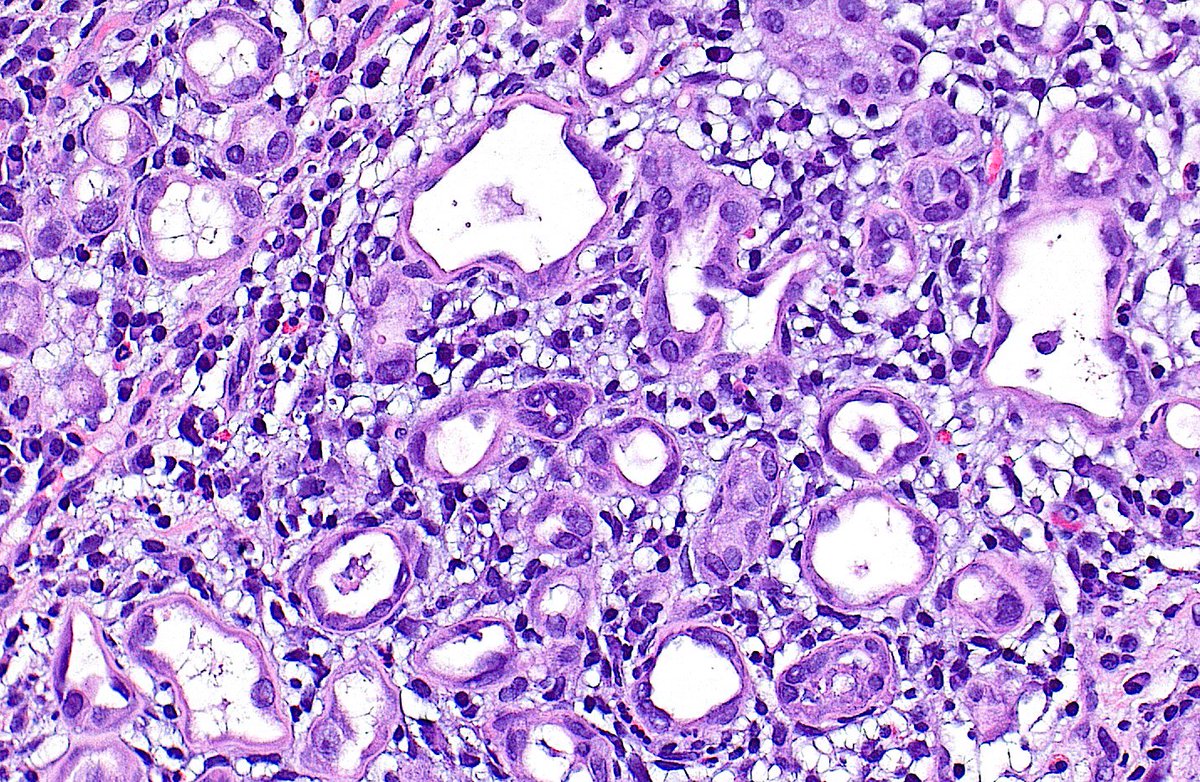 🔬 Nephrogenic Adenoma ~ Tubules lined by single layer of flattened or hobnailed epithelium ~ #GUpath #Pathology #Urology