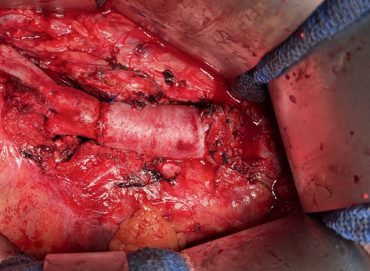 Xavier Berard (@xavierberardmd) on Twitter photo Discharged home POD12. Grateful for working with an incredible vascular infection multidisciplinary team <a href="/CHUBordeaux/">CHU de Bordeaux</a> with <a href="/charles_cazanav/">Charles.Cazanave</a> infectiology, anesthesiology, ICU, microbiology, pharmacology, nuclear medicine and radiology departments for 12 years 🚀🤩🤩🤩 Discharged home POD12. Grateful for working with an incredible vascular infection multidisciplinary team <a href="/CHUBordeaux/">CHU de Bordeaux</a> with <a href="/charles_cazanav/">Charles.Cazanave</a> infectiology, anesthesiology, ICU, microbiology, pharmacology, nuclear medicine and radiology departments for 12 years 🚀🤩🤩🤩