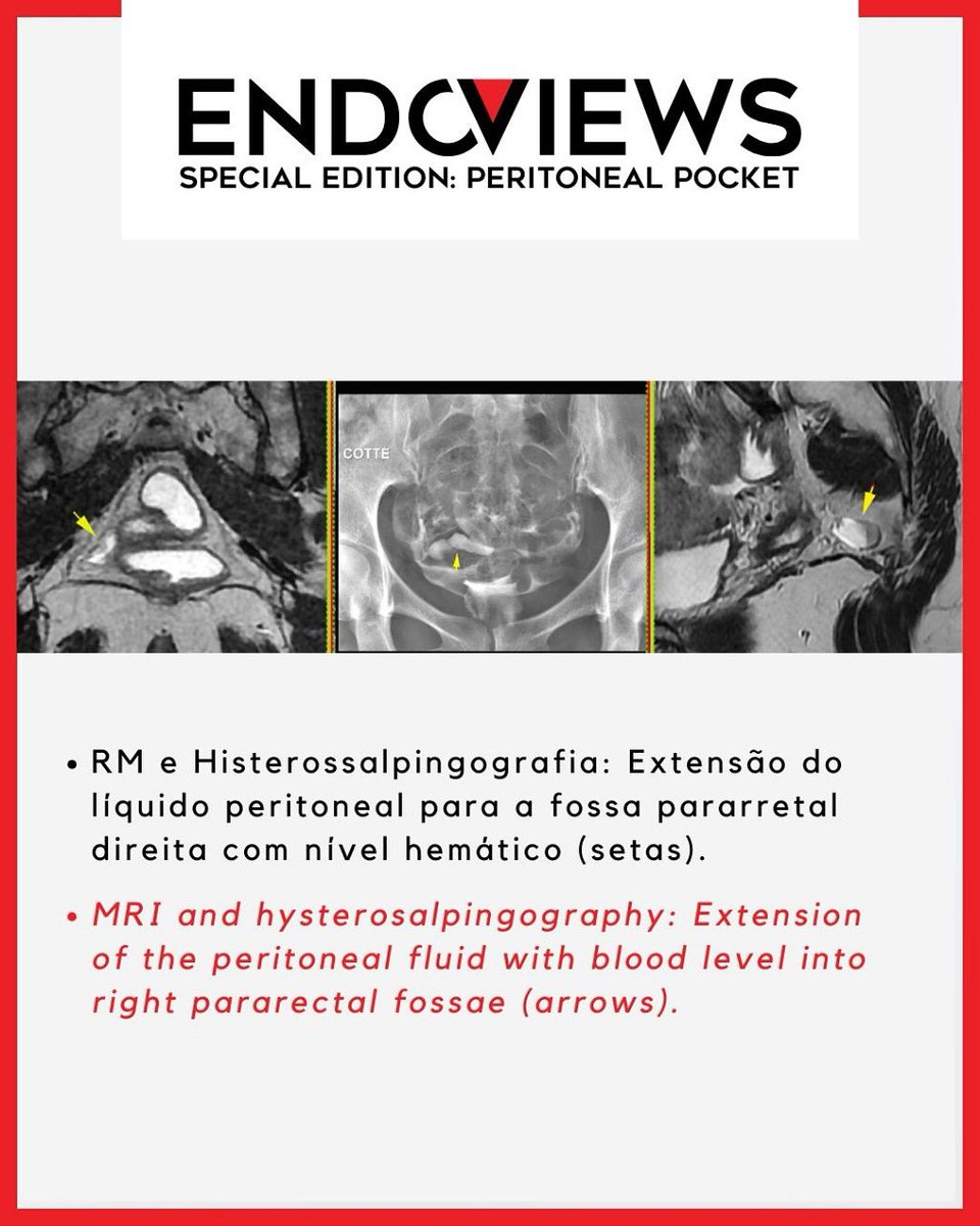 endoviews's tweet image. No post de hoje da Special Edition: Peritoneal Pockets, apresentamos a endometriose superficial anterior, com presença de líquido heterogêneo e espessamento do peritônio — achados importantes que podem indicar comprometimento peritoneal.