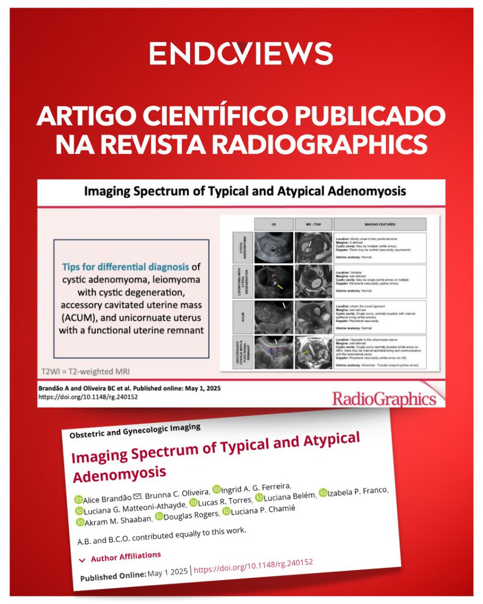 endoviews's tweet image. É com grande satisfação que compartilhamos com vocês este novo trabalho “Imaging spectrum of typical and atypical adenomyosis” publicado na prestigiosa revista Radiographics da RSNA - Sociedade Radiológica da América do Norte.