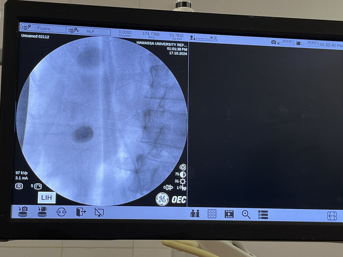Shekhar Biyani (@shekharbiyani) on Twitter photo ๐๐ Masterclass in action! <a href="/MrWillFinch/">Will Finch</a> successfully cleared a 1.5 cm diverticular stone using the old Lithoclast in #Hawassa, Ethiopia. Precision, skill, and global impact. <a href="/BAUSurology/">BAUS</a> <a href="/UrolinkUrology/">Urolink</a> <a href="/BAUSendourology/">BAUS Endourology</a> #Globalurology ๐๐ Masterclass in action! <a href="/MrWillFinch/">Will Finch</a> successfully cleared a 1.5 cm diverticular stone using the old Lithoclast in #Hawassa, Ethiopia. Precision, skill, and global impact. <a href="/BAUSurology/">BAUS</a> <a href="/UrolinkUrology/">Urolink</a> <a href="/BAUSendourology/">BAUS Endourology</a> #Globalurology