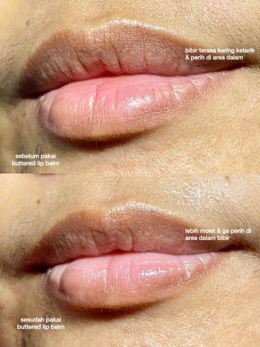 mamooong's tweet photo. PLEASE mulai skrg pakai lip balm yg ber-SPF dan ngelembabin bibir sekaligus ya!! bukan cuma kulit yg harus diproteksi, tp bibir juga butuh supaya ga gampang menggelap

aku udah pakai dari lama @buttered_id lip balm! cobain dulu 1 pasti ketagihan 😙
#diniskinjournal https://t.co/q4uK067rkq