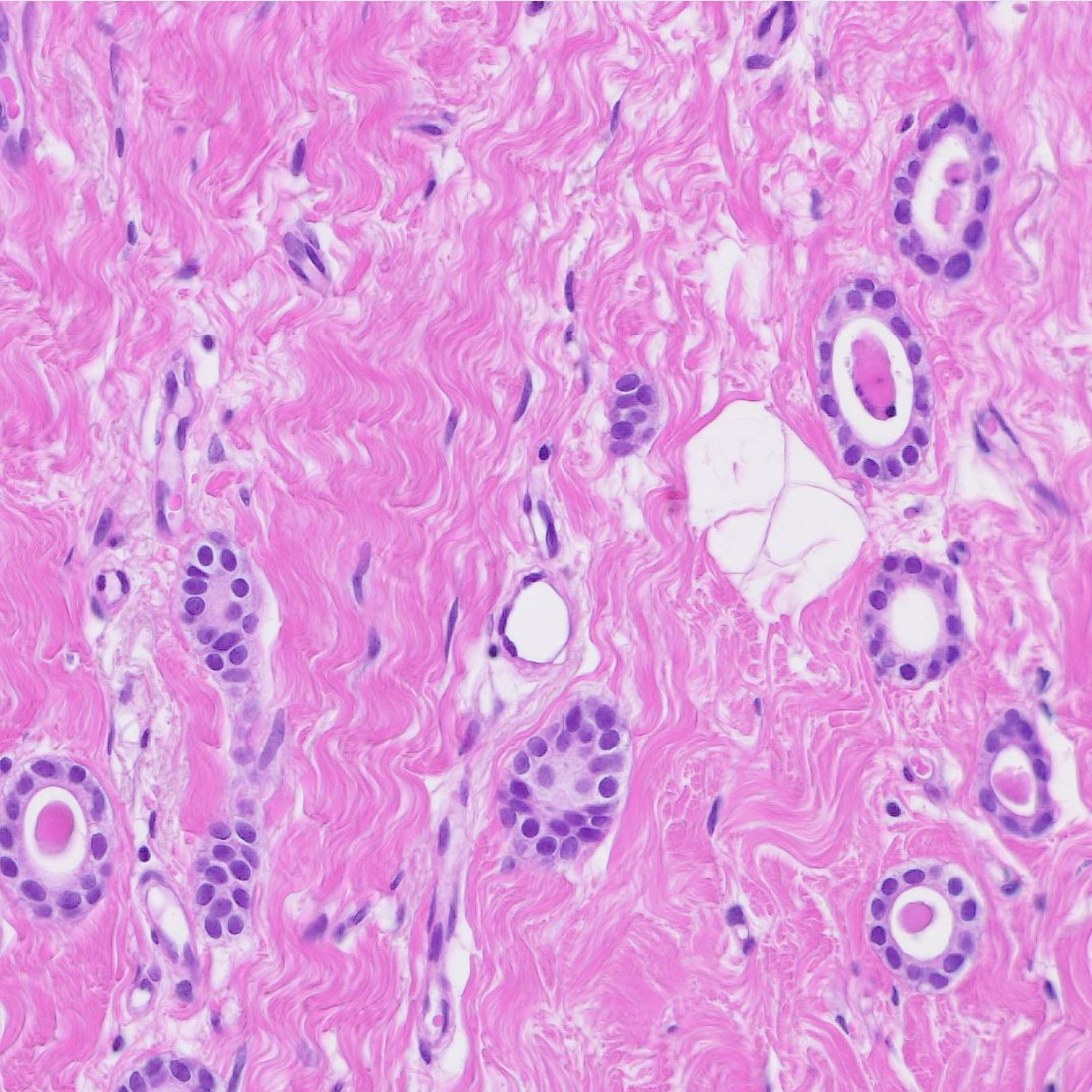 Rosenrot_Path's tweet photo. Microglandular adenosis (MGA). Characteristic eosinophilic secretions are surrounded by single layer of cuboidal cells. Glands are haphazardly infiltrating into fibrous or adipose tissue. 25 - 30% of MGA are associated with invasive carcinoma (fourth picture).
#BreastPath https://t.co/xMzVVpqtID