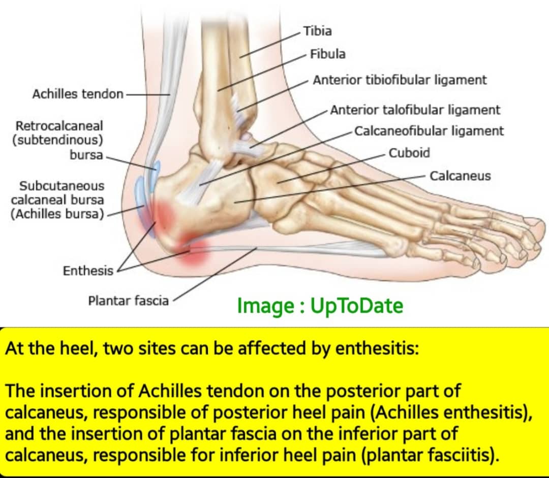 🛑The attached image by 'UpToDate" showing, two sites at the heel, which can be affected by enthesitis .

The enthesis is the site of insertion of ligaments, tendons, joint capsules,&amp; fascia to bone . These areas are highly vascular &amp; susceptible to bacterial &amp; antigen deposition