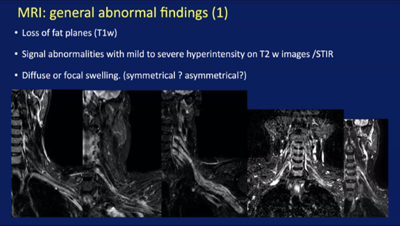 ESHNRSociety's tweet image. @ESHNRSociety webinar “Brachial plexus imaging” MRI geheral abnormal findings of BP from Simonetta Guerevini (Cremona/Italy)
Moderator: Yeliz Pekcevik @Ypekcevik (Izmir/TR)