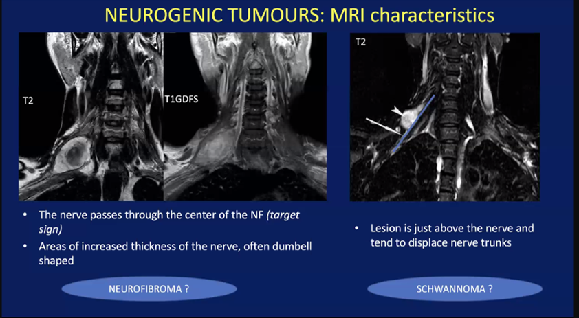 ESHNRSociety's tweet image. @ESHNRSociety webinar “Brachial plexus imaging”.
Neurofibroma vs Schwannoma of BP from Simonetta Guerevini (Cremona/Italy)
Moderator: Yeliz Pekcevik @Ypekcevik (Izmir/TR)
