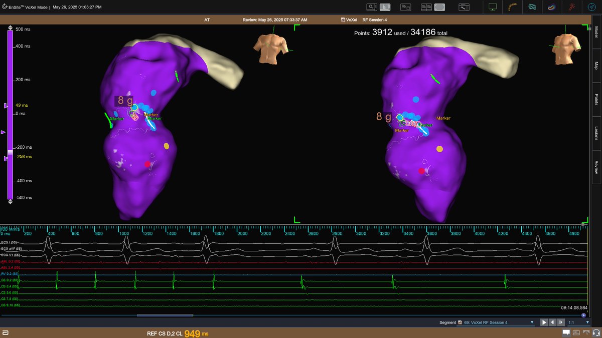 Bjork Fontan modification in 47 yrs old patient with DILV, LTGA. Nice anterior figure of 8 circuit around the Fontan baffle.