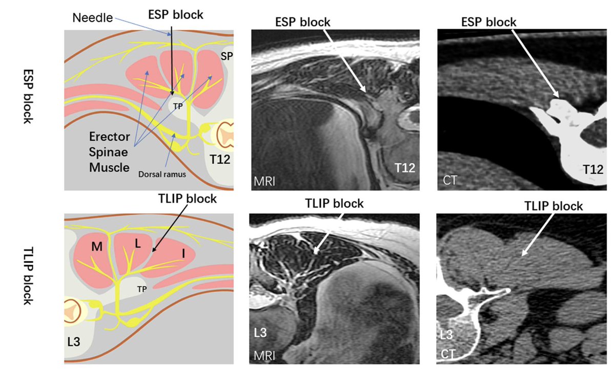Jon Bailey MD MSc FRCPC EDRA ๐จ๐ฆ๐ง๐โโ๏ธ (@jon_bailey_anes) on Twitter photo Random question:
How do you say TLIP? T-lip? Each letter separately?
<a href="/Ropivacaine/">Dr. Vishal Uppal MBBS, FRCA ๐จ๐ฆ๐ฎ๐ณ๐ด๓ ง๓ ข๓ ณ๓ ฃ๓ ด๓ ฟ</a>
<a href="/EMARIANOMD/">Ed Mariano, MD, MAS, FASA, FASRA ๐บ๐ธ๐ต๐ญ</a>
<a href="/KalagaraHari/">๐ฉบ Hari (เฐนเฐฐเฐฟ ๐ฎ๐ณ) Kalagara</a>
<a href="/dr_rajgupta/">Raj Gupta, MD, FASRA</a>
<a href="/bobfunn/">bob funnekotter</a>
<a href="/DrTimJen/">Tim Jen MD MHSc FRCPC</a>
<a href="/NavBahal/">Dr Nav Bahal</a>
<a href="/PeterMerjavy/">Peter Merjavy ๐บ๐ฆ ๎จ</a>
<a href="/PeterRoseAnesth/">Peter Rose</a>
<a href="/Steve_Coppens/">Steve Coppens</a>
<a href="/HouthoffKavita/">Kavita Houthoff Khemlani</a>
<a href="/garrettsbarry/">Garrett Barry</a>
<a href="/jeffgadsden/">Jeff Gadsden</a>
<a href="/mokaeleni/">Eleni Moka</a> Random question:
How do you say TLIP? T-lip? Each letter separately?
<a href="/Ropivacaine/">Dr. Vishal Uppal MBBS, FRCA ๐จ๐ฆ๐ฎ๐ณ๐ด๓ ง๓ ข๓ ณ๓ ฃ๓ ด๓ ฟ</a>
<a href="/EMARIANOMD/">Ed Mariano, MD, MAS, FASA, FASRA ๐บ๐ธ๐ต๐ญ</a>
<a href="/KalagaraHari/">๐ฉบ Hari (เฐนเฐฐเฐฟ ๐ฎ๐ณ) Kalagara</a>
<a href="/dr_rajgupta/">Raj Gupta, MD, FASRA</a>
<a href="/bobfunn/">bob funnekotter</a>
<a href="/DrTimJen/">Tim Jen MD MHSc FRCPC</a>
<a href="/NavBahal/">Dr Nav Bahal</a>
<a href="/PeterMerjavy/">Peter Merjavy ๐บ๐ฆ ๎จ</a>
<a href="/PeterRoseAnesth/">Peter Rose</a>
<a href="/Steve_Coppens/">Steve Coppens</a>
<a href="/HouthoffKavita/">Kavita Houthoff Khemlani</a>
<a href="/garrettsbarry/">Garrett Barry</a>
<a href="/jeffgadsden/">Jeff Gadsden</a>
<a href="/mokaeleni/">Eleni Moka</a>