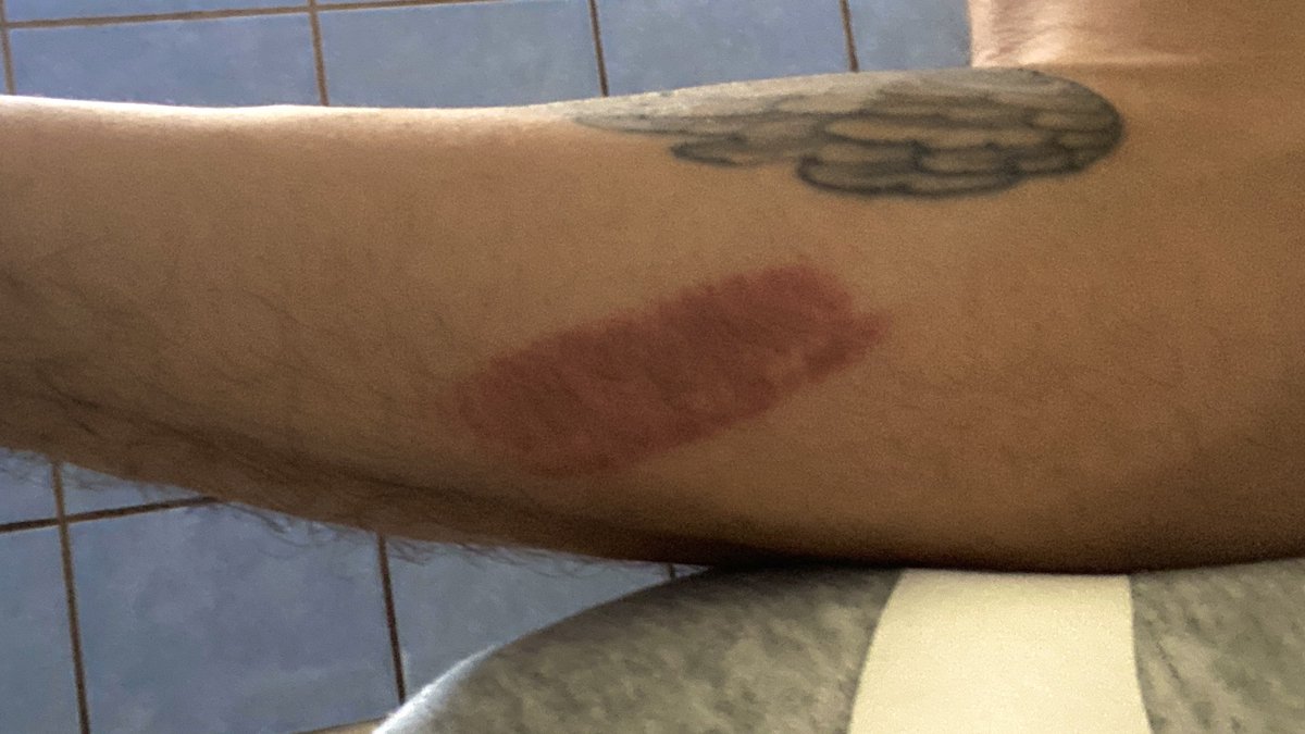 THANKS TO ALL WHO WISHED BURTHDAY HERE OR IN DMS ‼️🥹

I ALSO MANAGED TO BURN MY ARM ON THIS DAY HOrrRaYYY