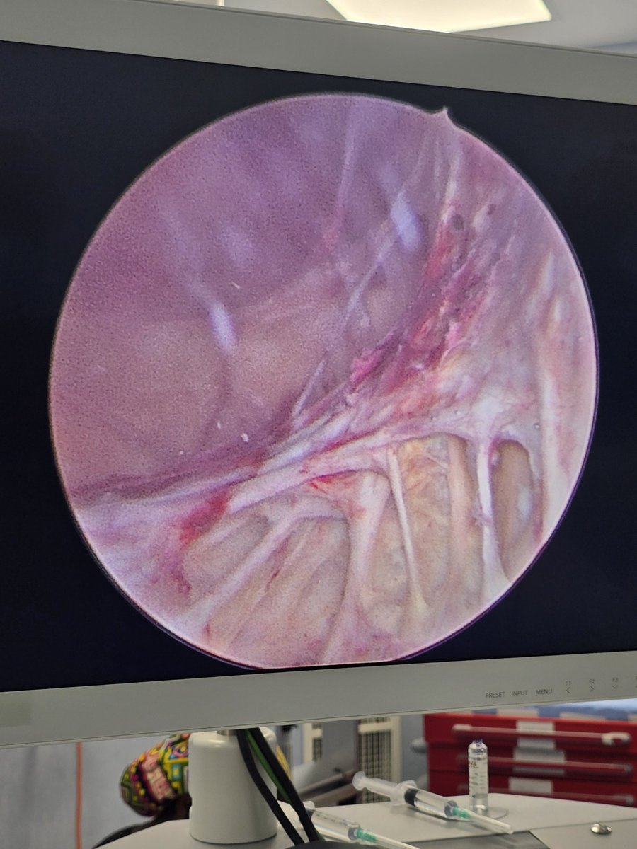 Ike Kweku Urologist🇬🇭 (@izickgh) on Twitter photo Anyone seen this on cystoscopy before? What are the differential diagnosis? <a href="/so_uro/">UroSoMe</a> <a href="/EuropeanUrology/">European Urology</a> <a href="/AmerUrological/">Amer. Urol. Assn.</a> <a href="/Uroweb/">European Association of Urology (EAU)</a> Anyone seen this on cystoscopy before? What are the differential diagnosis? <a href="/so_uro/">UroSoMe</a> <a href="/EuropeanUrology/">European Urology</a> <a href="/AmerUrological/">Amer. Urol. Assn.</a> <a href="/Uroweb/">European Association of Urology (EAU)</a>