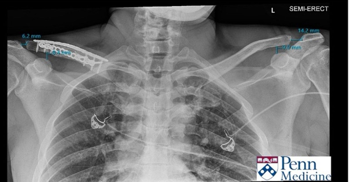 AuntMinnie.com (@auntminnie) on Twitter photo An interesting case for your assessment: 33-year-old man with chest and shoulder pain after MVA #radiology <a href="/PennMedicine/">Penn Medicine</a> buff.ly/AqnkEVh An interesting case for your assessment: 33-year-old man with chest and shoulder pain after MVA #radiology <a href="/PennMedicine/">Penn Medicine</a> buff.ly/AqnkEVh
