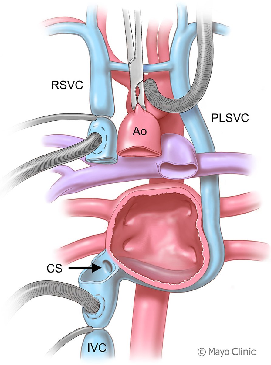 AATS (@aatshq) on Twitter photo #TrendingTuesday: The #18 most read AATS Journals article from 2024 is a case report on heart transplant for a patient with left superior vena cava. <a href="/MAlomariMD/">Mohammad Alomari MD</a>, Basar Sareyyupoglu et al. Read more from researchers at <a href="/MayoClinicCVS/">Mayo Clinic Cardiac Surgery</a> in #JTCVS Techniques: doi.org/10.1016/j.xjtc… #TrendingTuesday: The #18 most read AATS Journals article from 2024 is a case report on heart transplant for a patient with left superior vena cava. <a href="/MAlomariMD/">Mohammad Alomari MD</a>, Basar Sareyyupoglu et al. Read more from researchers at <a href="/MayoClinicCVS/">Mayo Clinic Cardiac Surgery</a> in #JTCVS Techniques: doi.org/10.1016/j.xjtc…