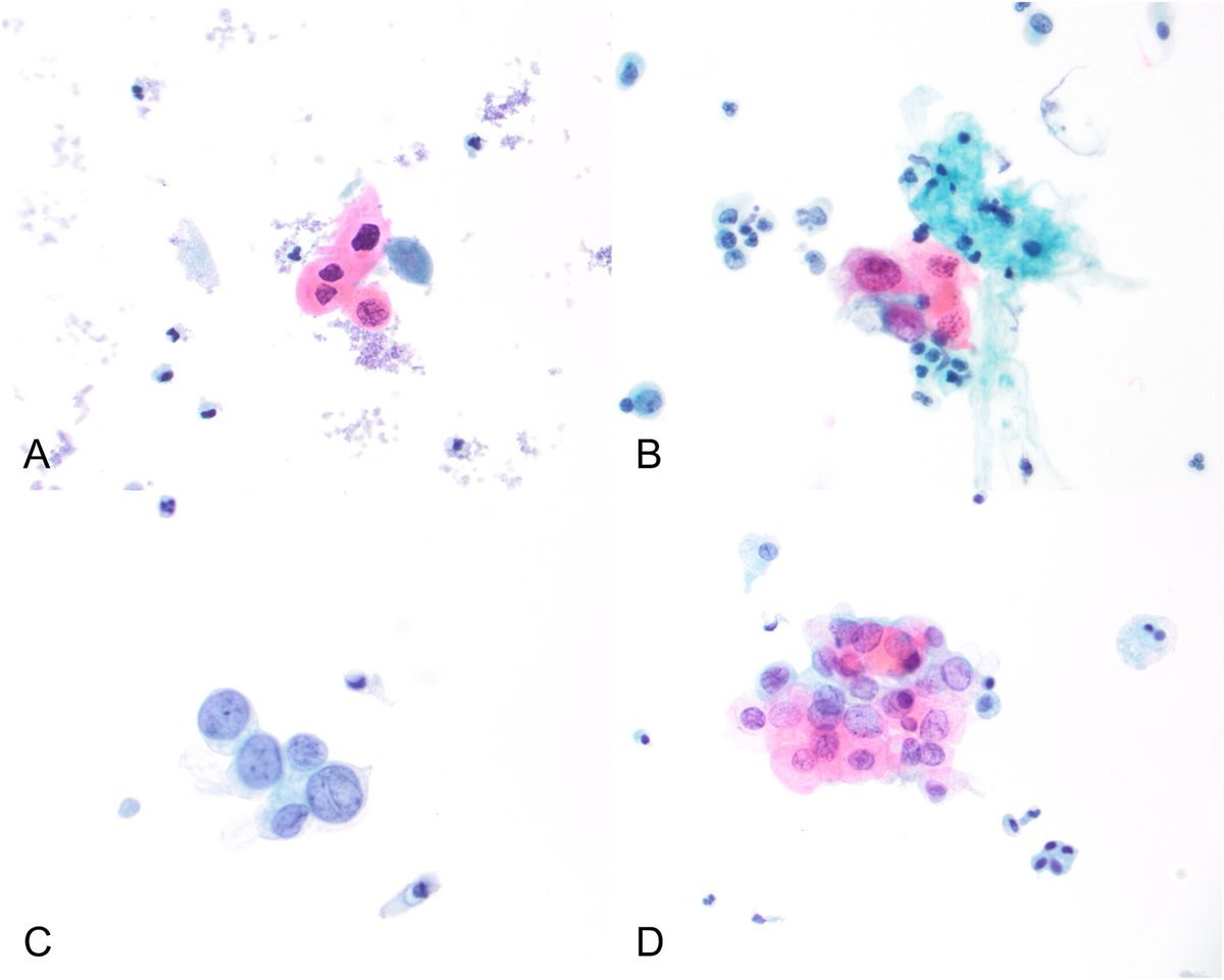 Cancer Cytopathology (@cancercytopath) on Twitter photo #OpenAccess! | HPV-positive UTCa can be identified reliably as HGUC by using TPS criteria; however, these cases may not be recognized as HPV-associated.
acsjournals.onlinelibrary.wiley.com/doi/full/10.10…
<a href="/PoonamVohra3/">Poonam Vohra MD</a> <a href="/UCSFPath/">UCSF Pathology</a> <a href="/DianaEstherossi/">Esther Diana Rossi</a> #CytoPath #ParisSystem #OpenAccess! | HPV-positive UTCa can be identified reliably as HGUC by using TPS criteria; however, these cases may not be recognized as HPV-associated.
acsjournals.onlinelibrary.wiley.com/doi/full/10.10…
<a href="/PoonamVohra3/">Poonam Vohra MD</a> <a href="/UCSFPath/">UCSF Pathology</a> <a href="/DianaEstherossi/">Esther Diana Rossi</a> #CytoPath #ParisSystem