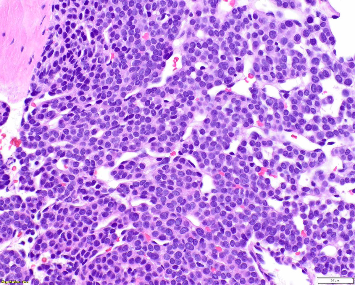 ModernPathology's tweet image. Needle biopsy of a gastric glomus tumor; in this location, a neuroendocrine (carcinoid) tumor would be considered. 
These lesions sport various molecular alterations, but immunohistochemistry can confirm the diagnosis.
Iwamura R, et al. PDGFRB and NOTCH3 Mutations are Detectable…