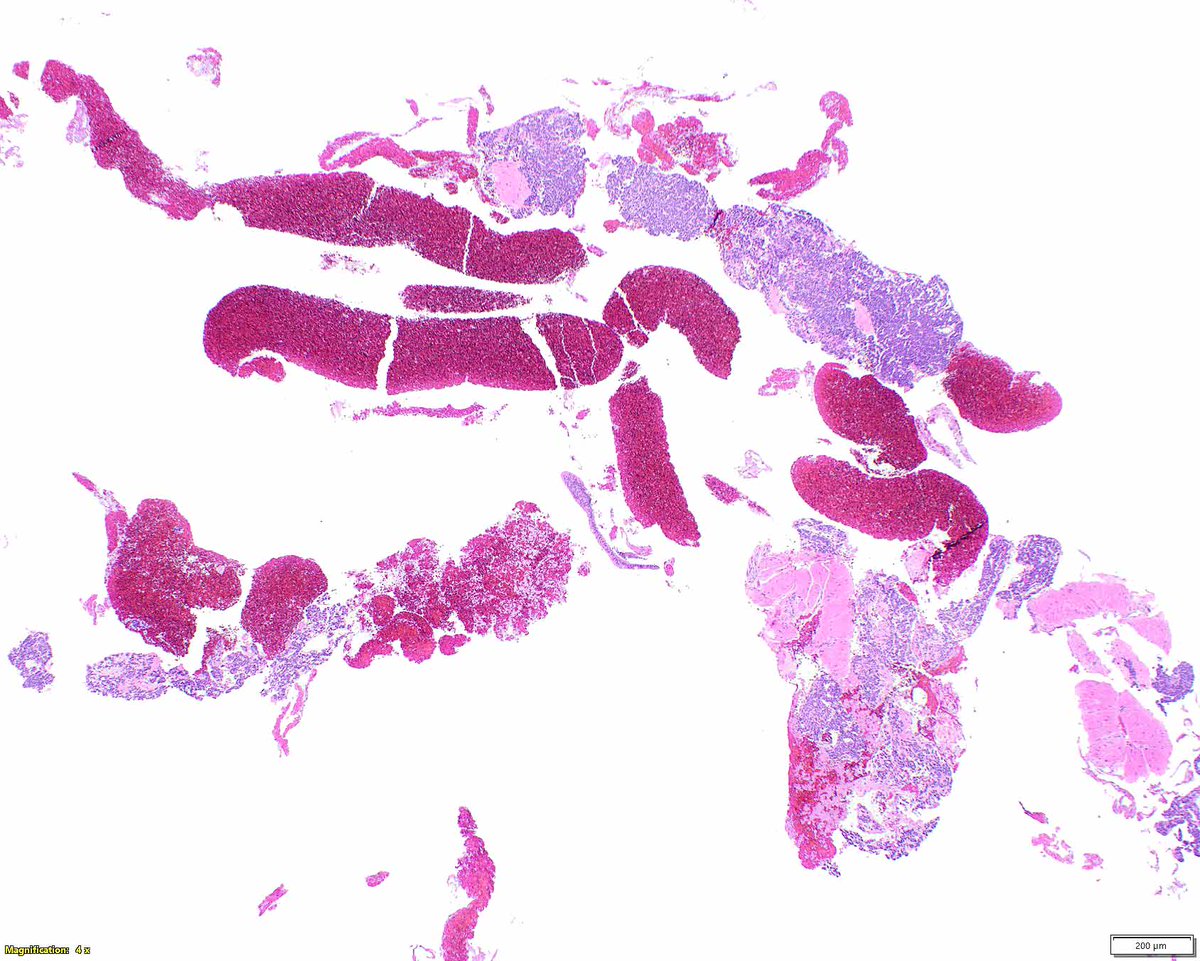 ModernPathology's tweet image. Needle biopsy of a gastric glomus tumor; in this location, a neuroendocrine (carcinoid) tumor would be considered. 
These lesions sport various molecular alterations, but immunohistochemistry can confirm the diagnosis.
Iwamura R, et al. PDGFRB and NOTCH3 Mutations are Detectable…