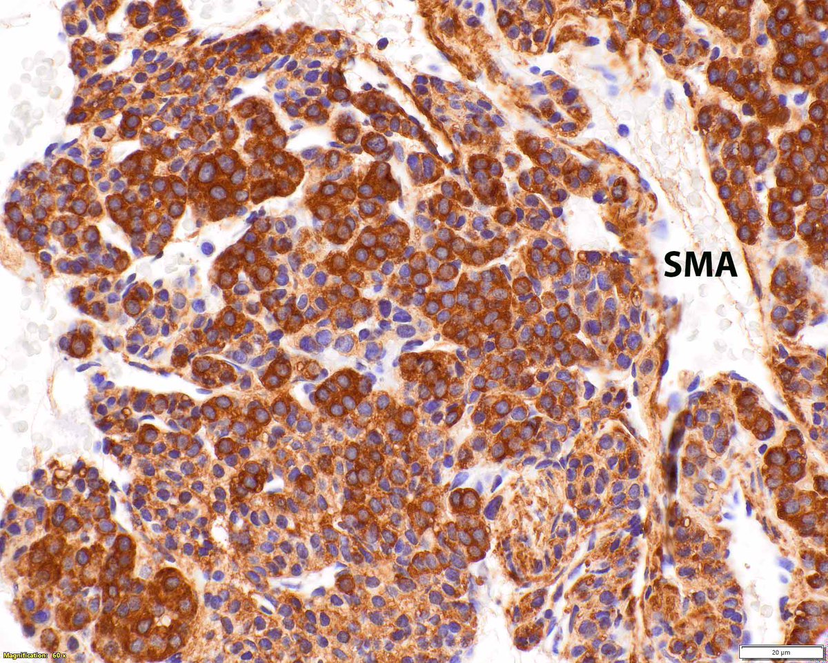 ModernPathology's tweet image. Needle biopsy of a gastric glomus tumor; in this location, a neuroendocrine (carcinoid) tumor would be considered. 
These lesions sport various molecular alterations, but immunohistochemistry can confirm the diagnosis.
Iwamura R, et al. PDGFRB and NOTCH3 Mutations are Detectable…