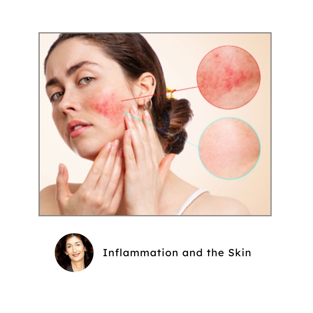 Inflammation and the Skin. Inflammation is the major cause of disease and aging. Inflammation and glycation are the chemical processes that change our appearance and age us internally and externally. #inflammationandskin youtu.be/x9zwpapXIJE