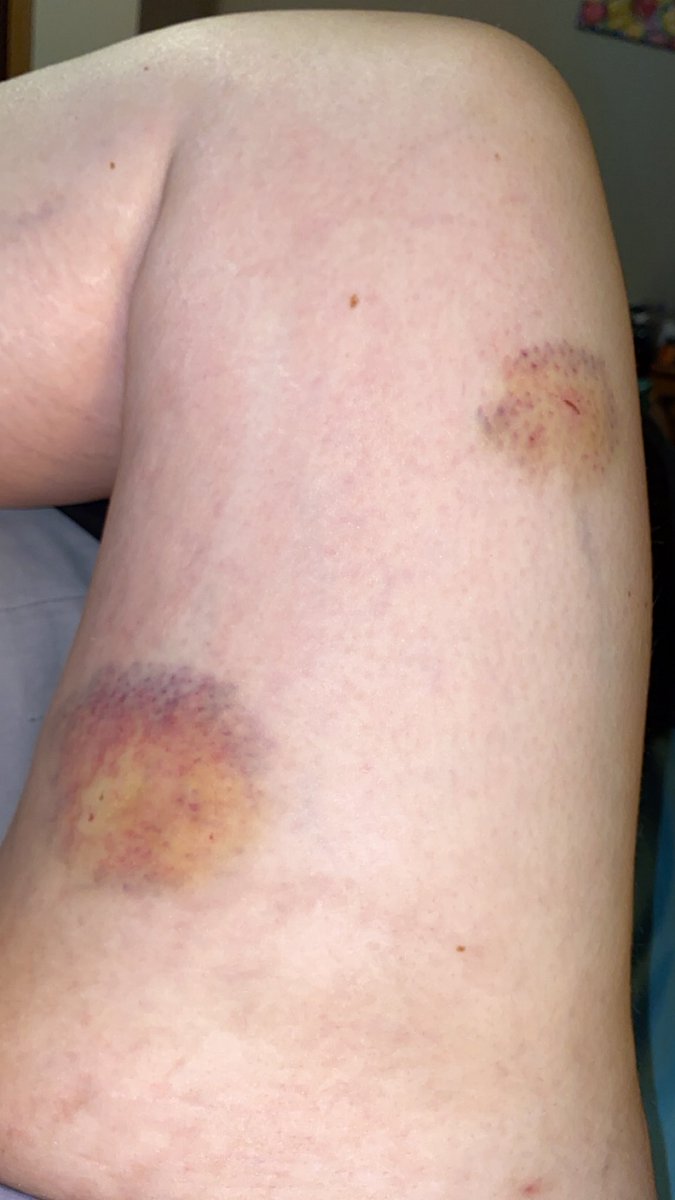 FoxyCimRe's tweet photo. @OrgasmicGroup Post impact-scene and then some love bites 😁

Après une scène d'impact et morsures d'amour 😁

#kink #impact #bites #bruises
#morsuresdamour #bleus https://t.co/JFPao38cYd
