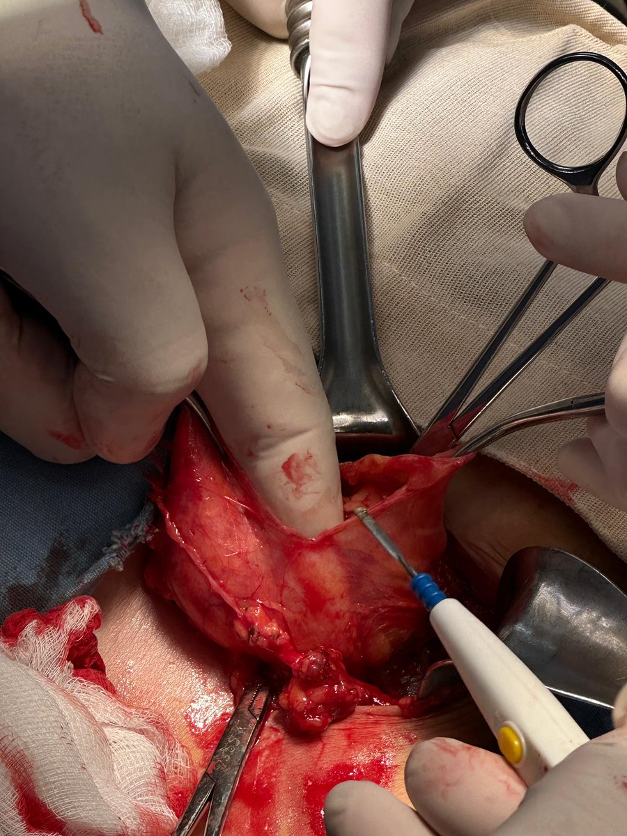 DrJAVazquez's tweet photo. Mínimamente invasivo, no siempre es sinónimo de laparoscopia. Plastía inguinal Lichtenstein #LaParedImporta #SoMe4Surgery #SoME4IQLatAm #surgicalmentor https://t.co/IxAoWU8zxq