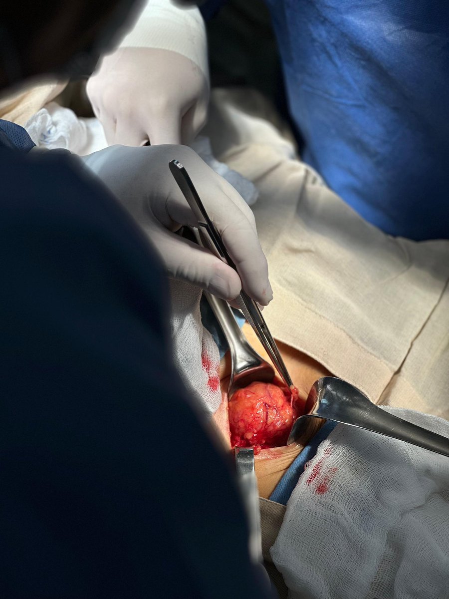 DrJAVazquez's tweet photo. Mínimamente invasivo, no siempre es sinónimo de laparoscopia. Plastía inguinal Lichtenstein #LaParedImporta #SoMe4Surgery #SoME4IQLatAm #surgicalmentor https://t.co/IxAoWU8zxq