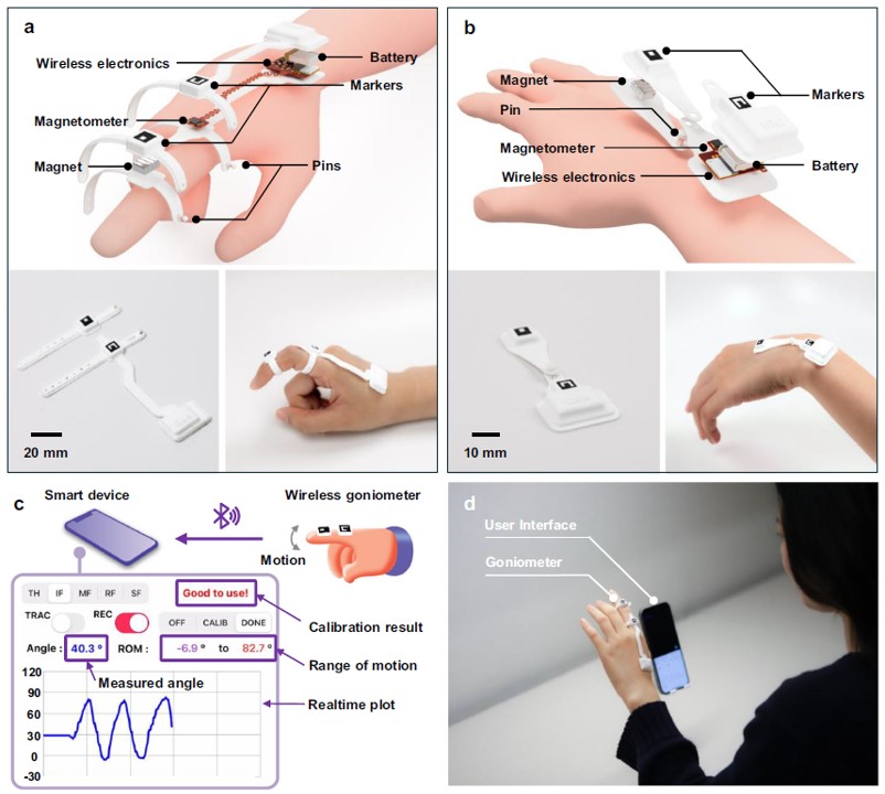 John A Rogers (@profjohnarogers) on Twitter photo Another paper (link below) from the group - this one, published in <a href="/NatureComms/">Nature Communications</a>, introduces a wireless wearable electrogoniometry system for accurate, real-time monitoring of joint angles in the hand and wrist, designed to aid hand physiotherapy in both supervised and Another paper (link below) from the group - this one, published in <a href="/NatureComms/">Nature Communications</a>, introduces a wireless wearable electrogoniometry system for accurate, real-time monitoring of joint angles in the hand and wrist, designed to aid hand physiotherapy in both supervised and