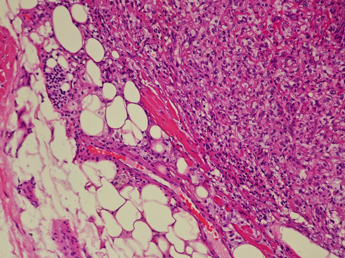 MirunaPopescu13's tweet photo. Dermatofibroma.
➡️ Mixed cell population, hemosiderin deposition
➡️This one shows Touton-like giant cells
➡️Typical collagen entrapment
➡️May show fat infiltration mimicking DFSP, but shows associated fat necrosis (DFSP which doesn't damage fat)
#PathTwitter #dermpath #BSTpath https://t.co/NCvXcroJW0