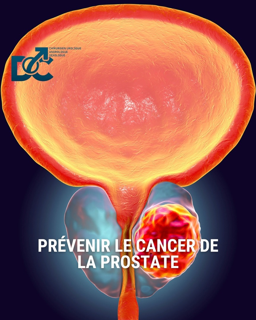 Prévenir le cancer de la prostate repose sur une hygiène de vie saine, une surveillance médicale adaptée à l’âge et aux facteurs de risque, et des choix alimentaires protecteurs. Voici les clés principales :

🩺 1. Surveillance médicale régulière
👨‍⚕️ Dépi… instagr.am/p/DKFsaRaNo89/