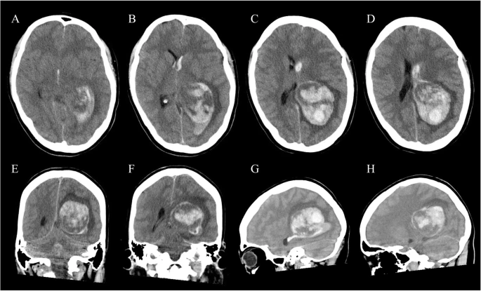 🚨A 28-year-old woman becomes comatose after sudden headache and vomiting. No history of trauma; previously healthy except for episodic migraines. Intraventricular hemorrhage is identified on initial imaging.

🕵️What could underlie this presentation in this young patient?
