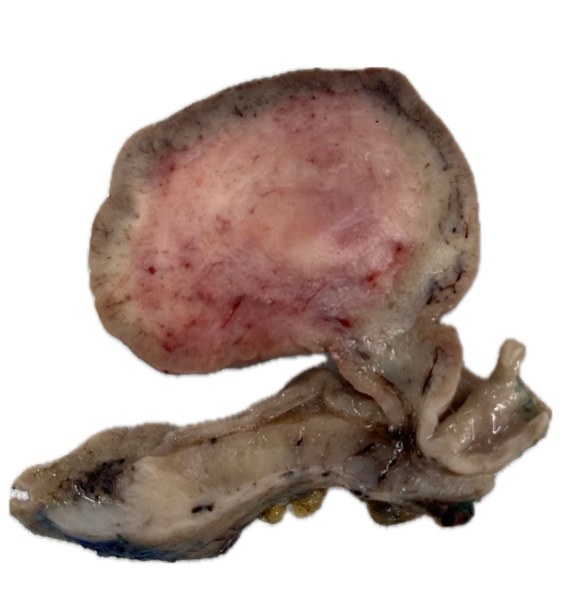 The art of grossing. A 68 years old woman with abdominal pain. Final Dx. 3x2cm Gastric Inflammatory Fibroid Polyp. #pathologists #pathresidents #pathTweeter #GIpath