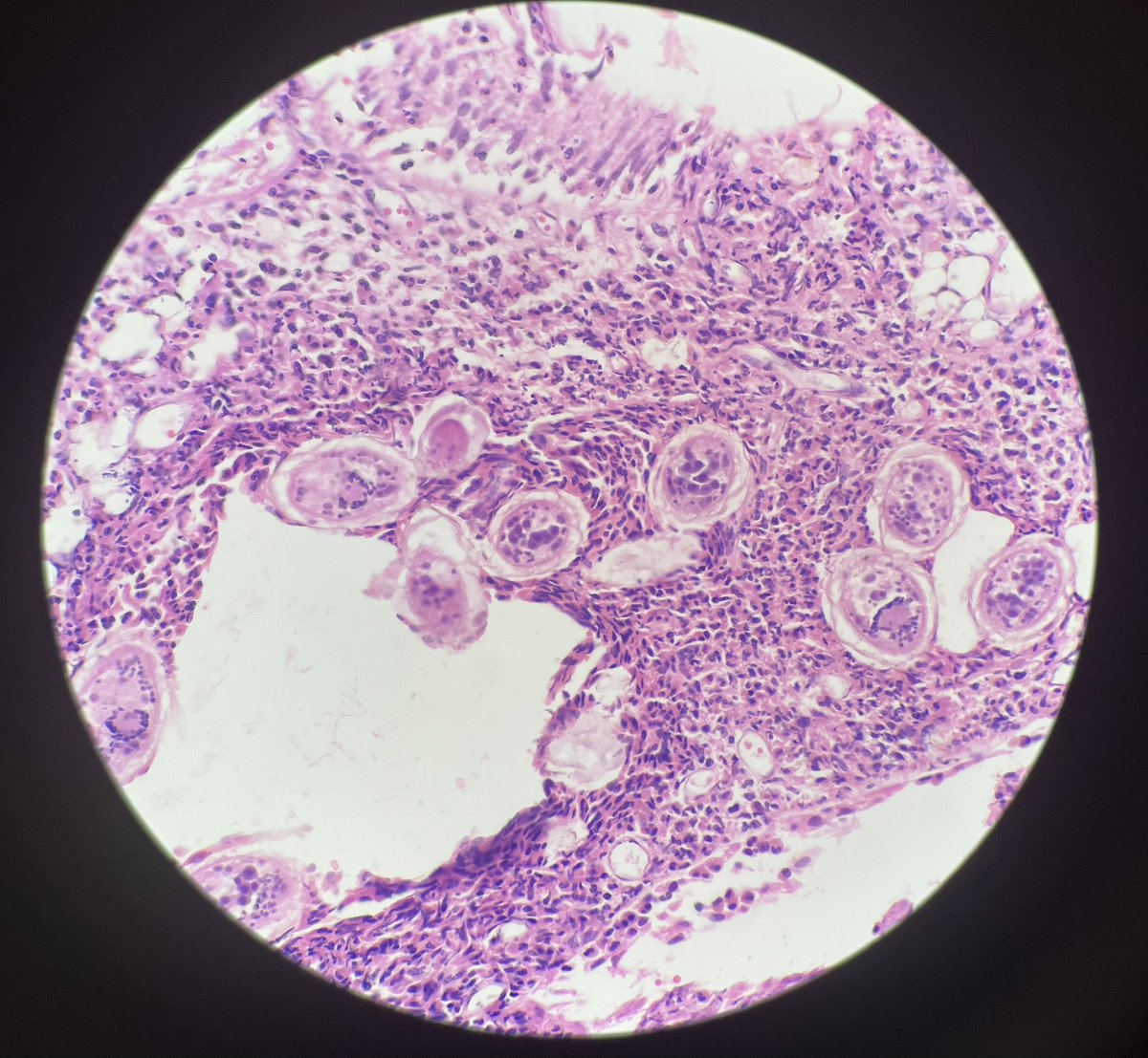 A 27 y/o male, recently moved to the US, presents with hematuria. Bladder wall biopsy (H&amp;E) shows numerous oval structures with eosinophilic shells, surrounded by granulomatous inflammation.
Schistosoma eggs!!
Seen it? It’s unforgettable. 

#PathTwitter #Histopathology #PathX