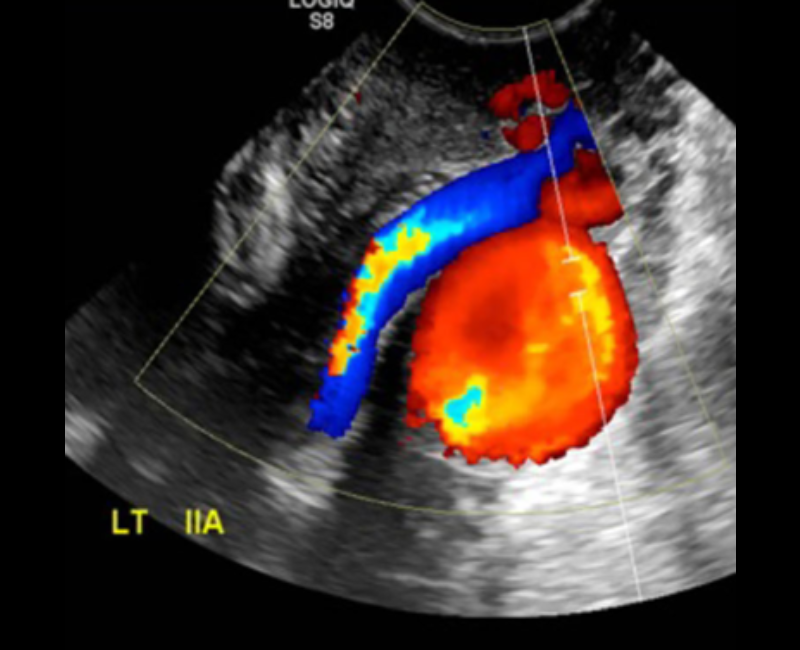 ASA (@asasonography) on Twitter photo đ This Sonography case report describes a rare case of a large unruptured isolated internal iliac artery aneurysm found coincidentally in a routine female pelvic ultrasound. #SupportingSonographers <a href="/WileyHealth/">Wiley Clinical Health</a>
loom.ly/KW1VFxs đ This Sonography case report describes a rare case of a large unruptured isolated internal iliac artery aneurysm found coincidentally in a routine female pelvic ultrasound. #SupportingSonographers <a href="/WileyHealth/">Wiley Clinical Health</a>
loom.ly/KW1VFxs