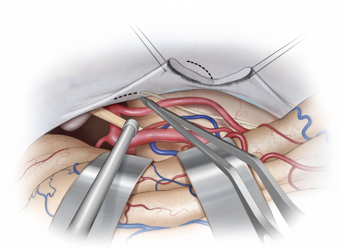 Trochlear nerve should be dissected from its dural canal up to its entrance in the cavernous sinus. The trochlear nerve is free of the tentorial flap, creating a supra- and infratrochlear working window. 

Learn more here | zurl.co/pUmrz 

#Neurosurgery