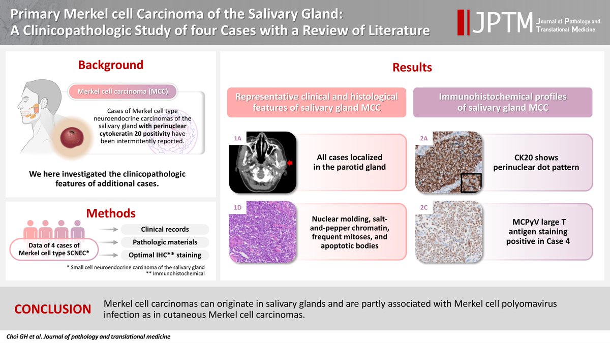 Primary Merkel cell carcinoma of the salivary gland: a clinicopathologic study of four cases with a review of literature
Original Article by Dr. Gyuheon Choi et al.
doi.org/10.4132/jptm.2…
#PathTwitter