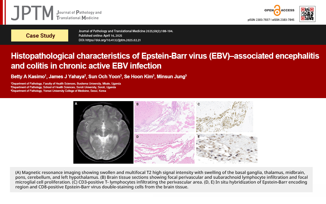 Histopathological characteristics of Epstein-Barr virus (EBV)–associated encephalitis and colitis in chronic active EBV infection
Case Study by Dr. Betty A Kasimo et al.
doi.org/10.4132/jptm.2…
#PathTwitter
