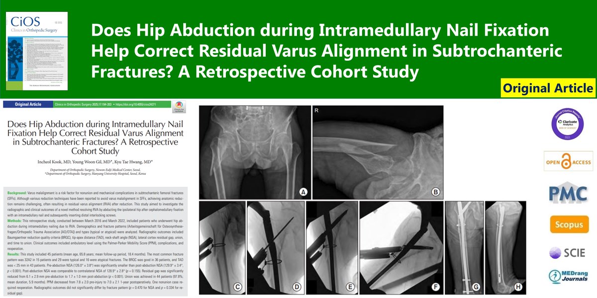 Does Hip Abduction during Intramedullary Nail Fixation Help Correct Residual Varus Alignment in Subtrochanteric Fractures? A Retrospective Cohort Study
🌷doi.org/10.4055/cios24…
Clin Orthop Surg. 2024 Dec;16(6)Incheol Kook
#Varus_deformity #Intramedullary_nail #Hip_abduction